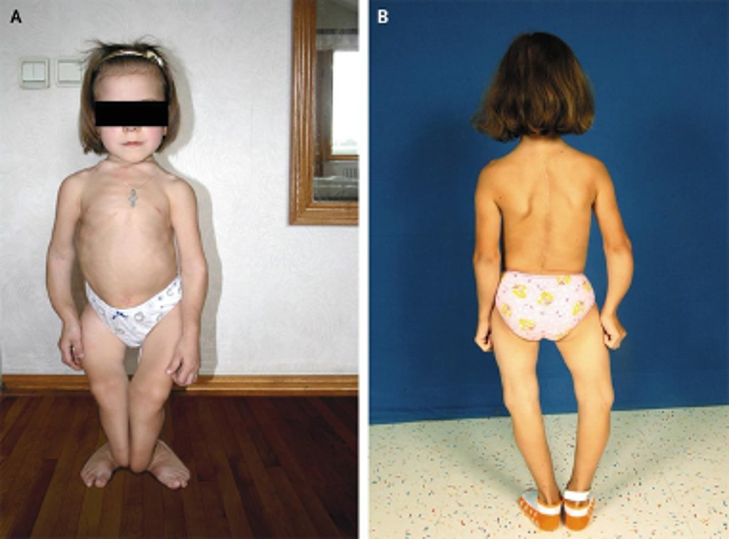<p>deficiency in this vitamin is associated with Rickets in infants, leading to:</p><p>•Growth impairment</p><p>•Irritability</p><p>•Significant bowing of bones</p><p>•Hypomineralization of teeth</p>