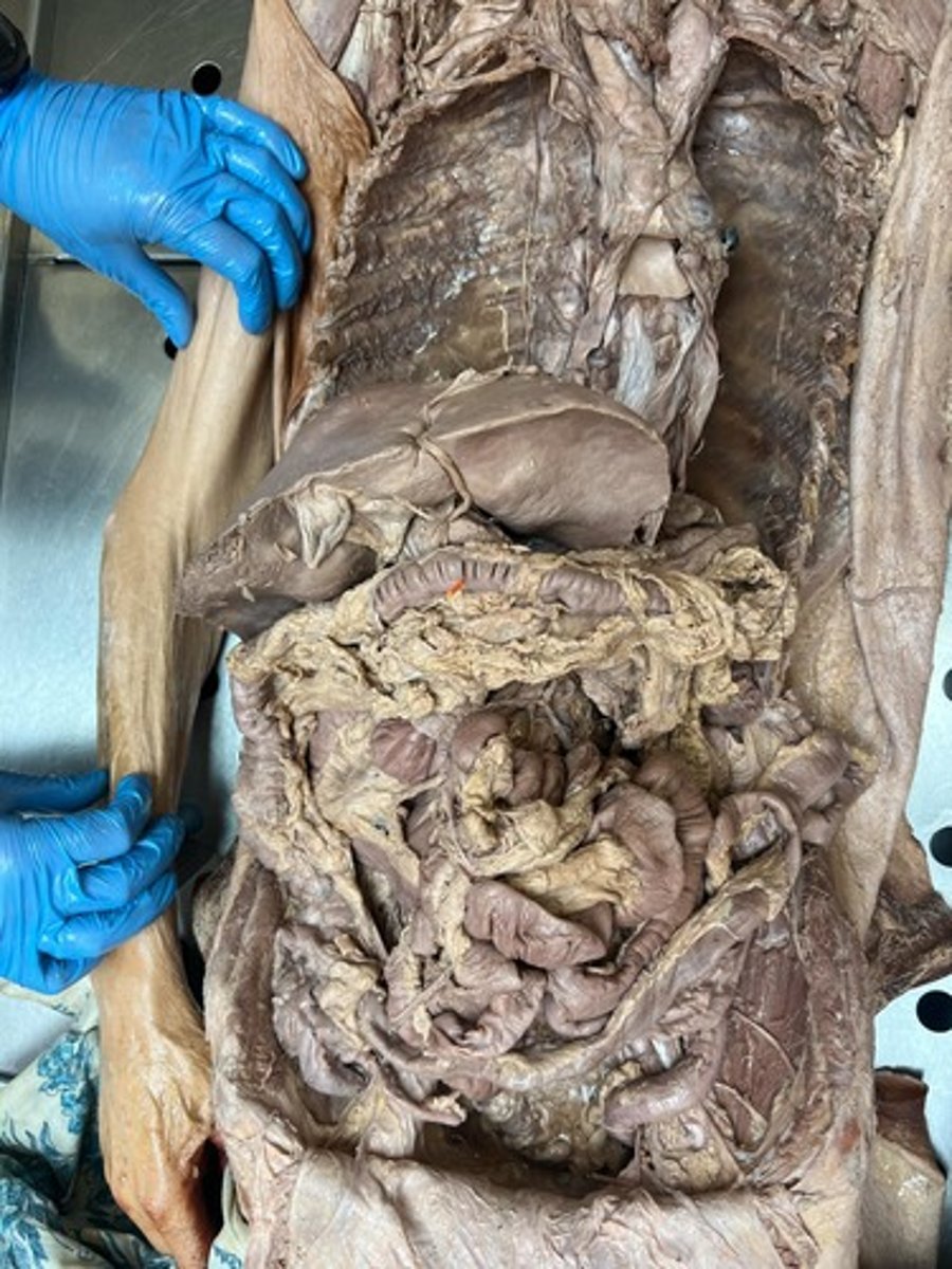 <p>tranverse colon</p>