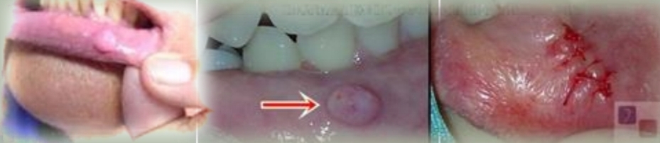 <p><strong><u>Irritation fibroma</u></strong></p><p class="has-focus">Reactive hyperplastic lesion caused by chronic trauma and mimics tumor. </p><p class="has-focus">Limited growth potential</p><p class="has-focus"></p><p class="has-focus is-empty"><strong>Treatment</strong> - Excisional biopsy, may reccur if irritation continues.</p><p class="has-focus"></p><p class="has-focus is-empty"><em>DD - Fibrosing mucocele, Peripheral ossifying fibroma, Giant cell fibroma, Benign submucosal neoplasm.</em></p>