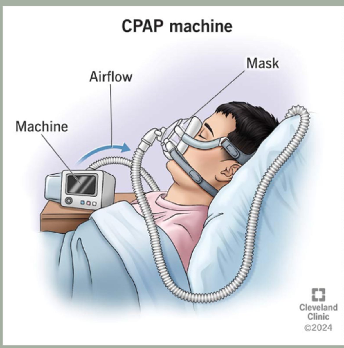 <p>-weight loss</p><p>-first line: CPAP for &gt;4hrs (reduced risk of heart disease and stoke </p><p>-avoid sedating medications and agents like alcohol </p><p>-Surgical interventions: uvulopalatopharyngoplasty, genioglossus</p><p>advancement, maxillomandibular advancement</p><p>-treat underlying conditions </p>
