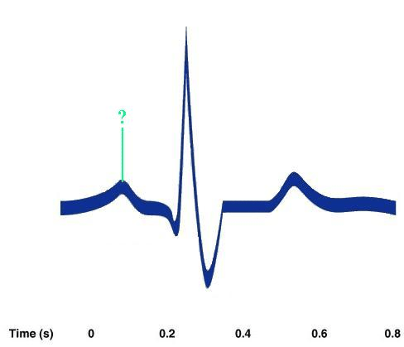 <p>Identify the indicated portion of the EKG.</p>