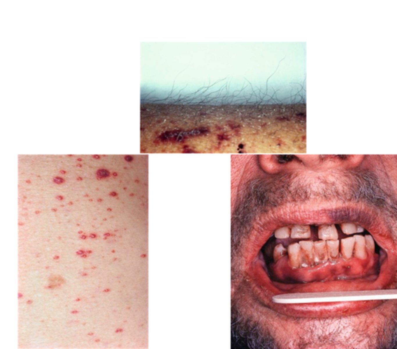 <p>1) Hemorrhagic signs - poor wound healing</p><p>2) Hyperkeratosis of fair follicles - corkscrew hairs</p><p>3) Hypochondriasis - psychological manifestations</p><p>4) Hematologic - impaired collagen synthesis & decreased iron absorption</p>