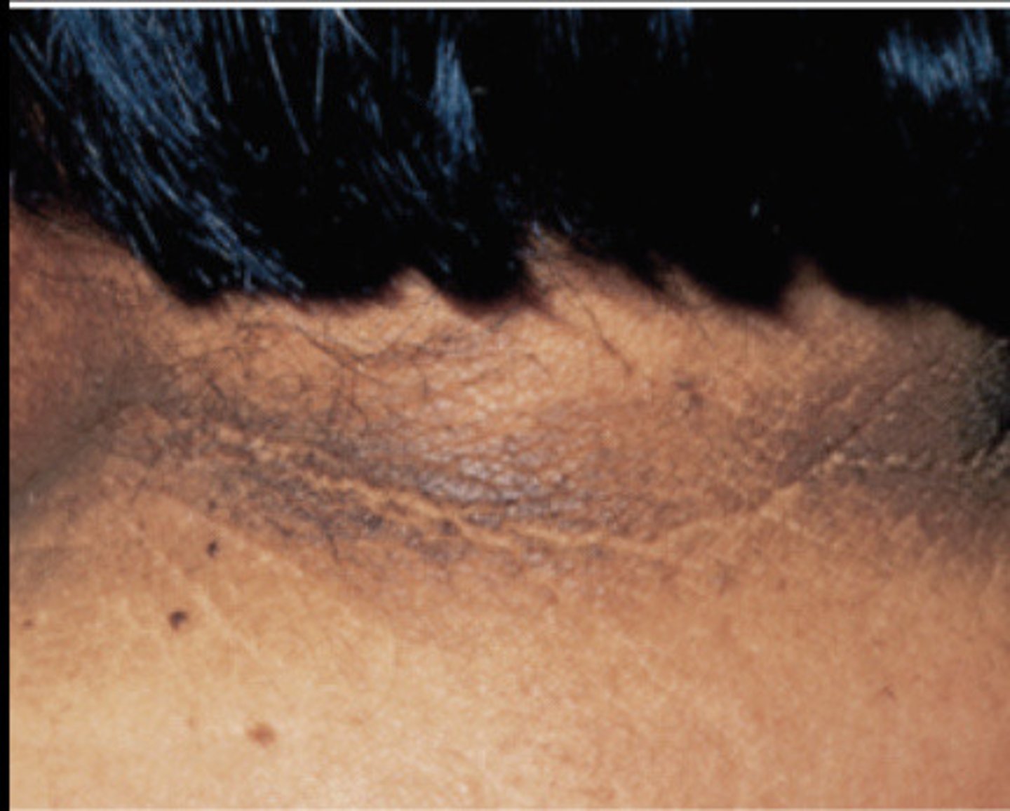 <p>Acanthosis Nigricans</p>