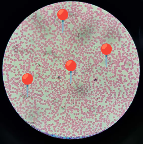 <p><span data-name="drop_of_blood" data-type="emoji">🩸</span><span data-name="microbe" data-type="emoji">🦠</span><span><span> </span></span><strong><em>Plasmodium falciparum </em></strong><sub>(Postać pierścienia)</sub></p><p></p><p></p><p><span>🔴 - postać pierścienia.</span></p><p></p><p></p><p><span>😷❓ </span><strong>Parazytoza:</strong><em> Malaria</em></p>