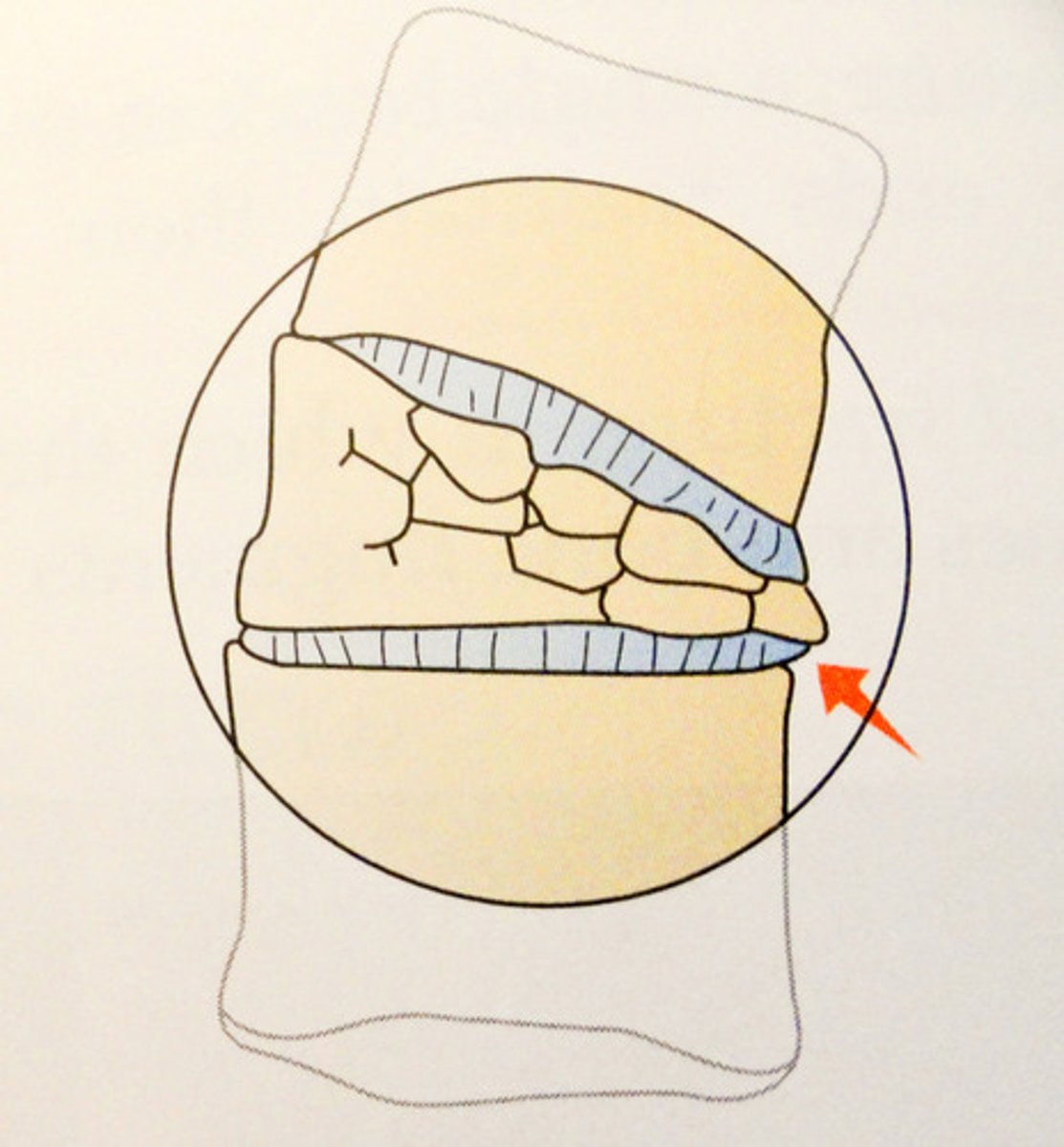 <p>A fracture in which the bone is pressed together on itself.</p>