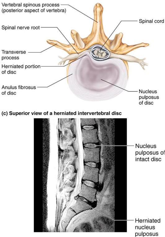 <ul><li><p>Cushion-like pad between vertebrae</p></li><li><p>Shock absorbers</p></li><li><p>2 Parts:</p><ul><li><p><strong>Nucleus Pulposus</strong>: Inner gelatinous nucleus</p></li><li><p><strong>Anulus Fibrosis</strong>: outer collar of collagen &amp; fibrocartilage</p></li></ul></li></ul><p></p>