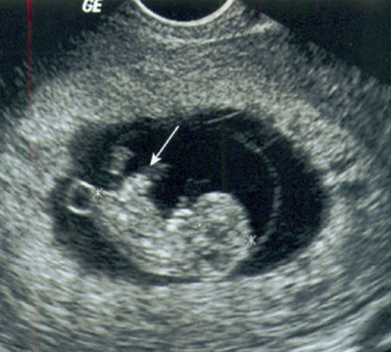 <p>Midgut herniation</p>