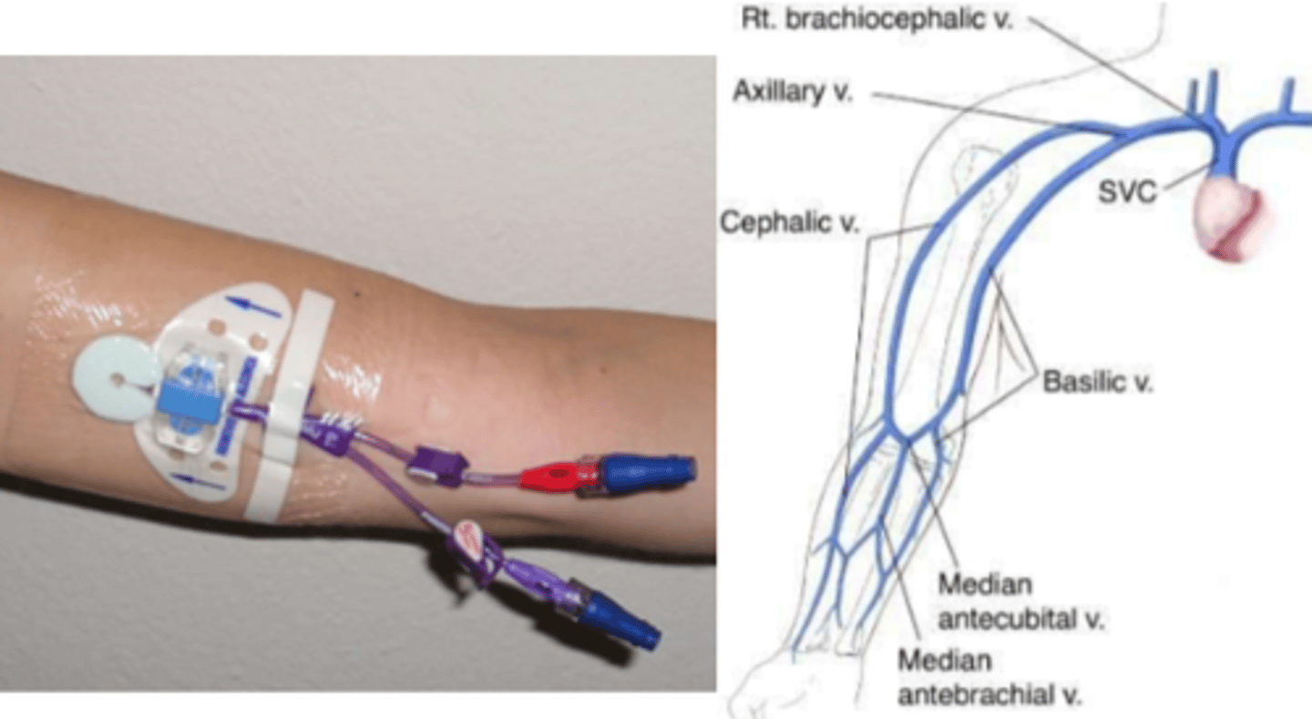 <p>Long peripheral catheter terminating in central circulation.</p>