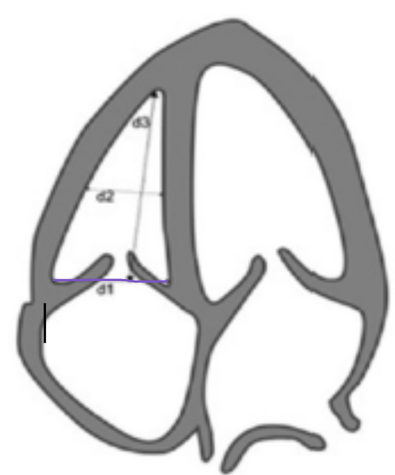 <p><span style="color: rgb(150, 3, 255);">Basal diameter</span> → base of chamber from corner to corner behind TV leaflets</p>