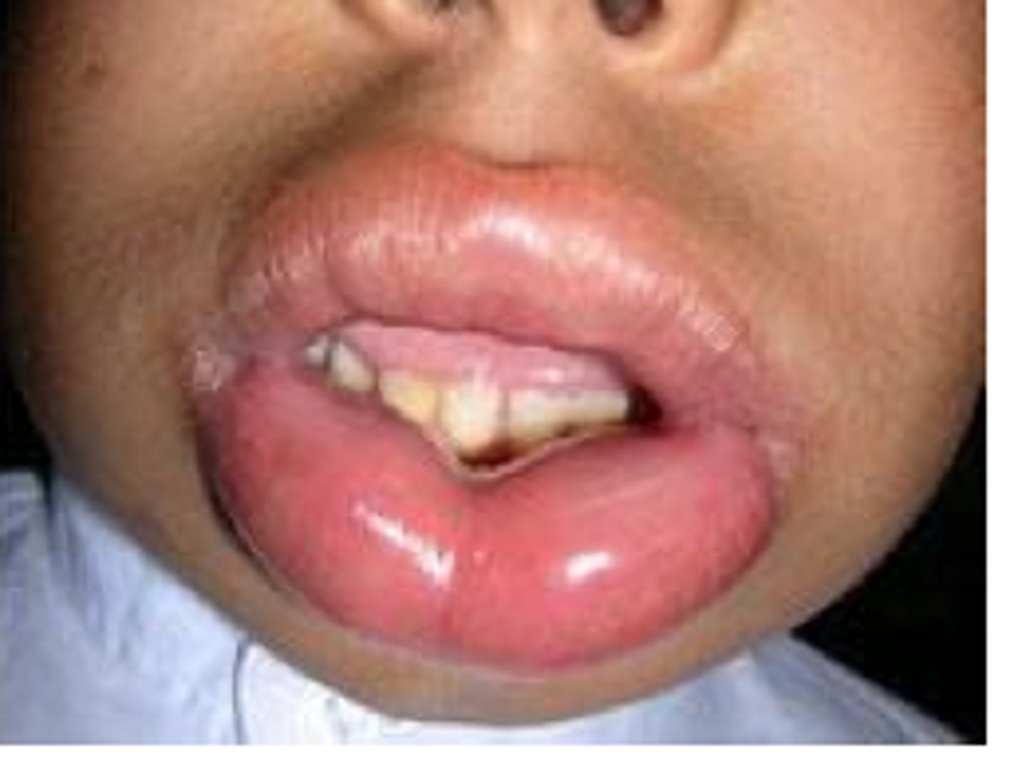 <p>Swelling of lower lip caused by allergies.</p><p>Sign of anaphylaxis</p>