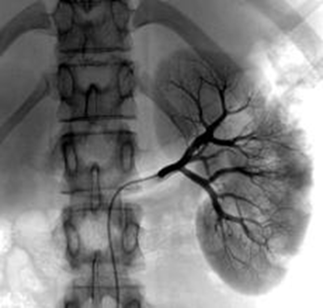 <p><strong><span class="bgB">Contrast via the femoral artery</span></strong> to view renal patency of renal vessels</p>