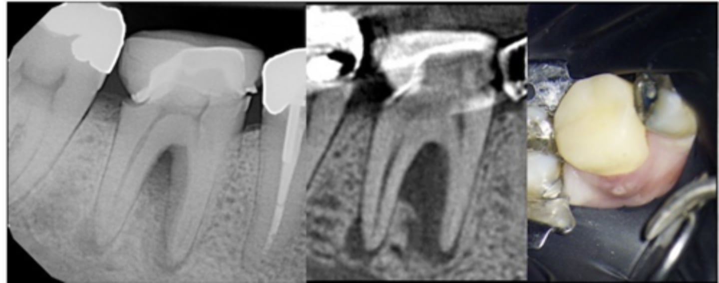 <p>Could this be a vertical root fracture or a crack?</p><p>- Tooth #30 CC: “There’s a bump on my gums”</p><p>- Sinus tract near B sulcus</p><p>- Probing: 12mm MB, 7mm B</p><p>- CBCT shows furcation bone loss joining with PARL at M apex; separate PARL at D apex; crestal bone appears WNL</p><p>- Pulpal dx: Necrotic</p><p>- Periapical dx: Chronic apical abscess</p>