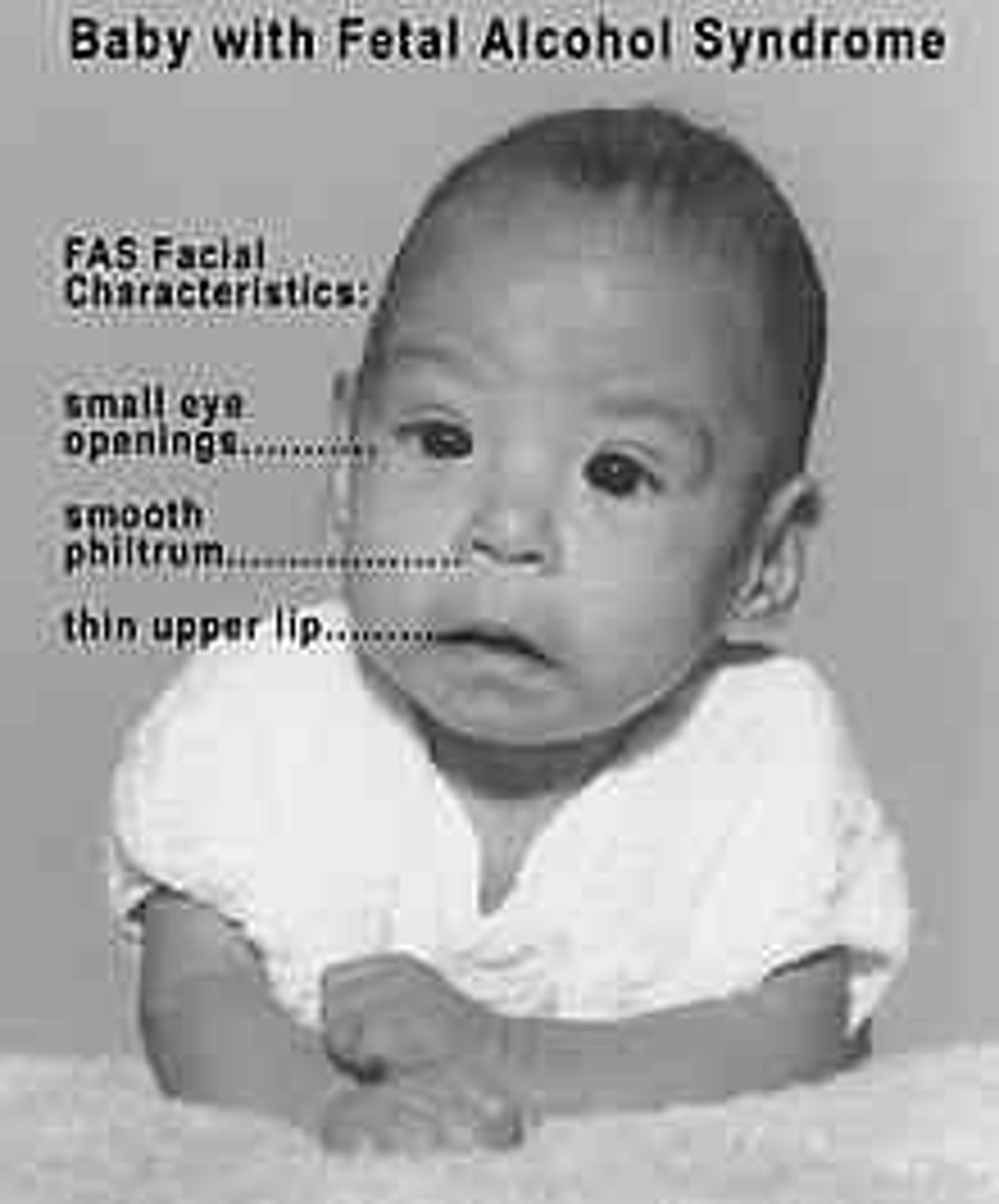 <p>Fetal alcohol syndrome</p>