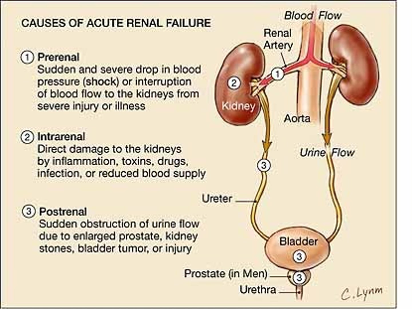 <p>Sudden decline in kidney function increase in BUN and creatine, oliguria, hyperkalemia, and sodium retention</p><p>-Prerenal--Shock, hemorrhage, burn, or PE</p><p>-Postrenal--Neoplasm, kidney stone, prostate hypertrophy</p><p>-Intrarenal--Toxins, intrarenal ischemia, vascular disorders</p>