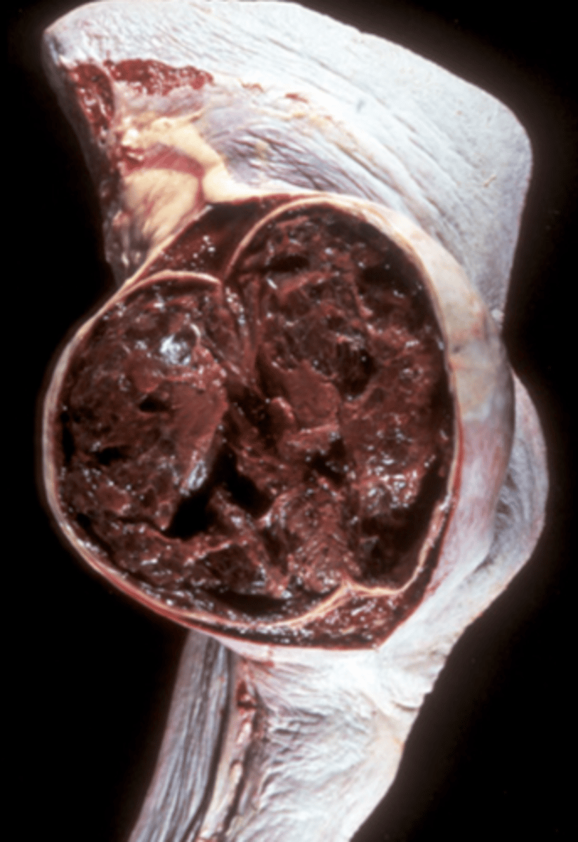 <p>This is a result to damage to the splenic red pulp and its vessels. What is being shown in this photo?</p>