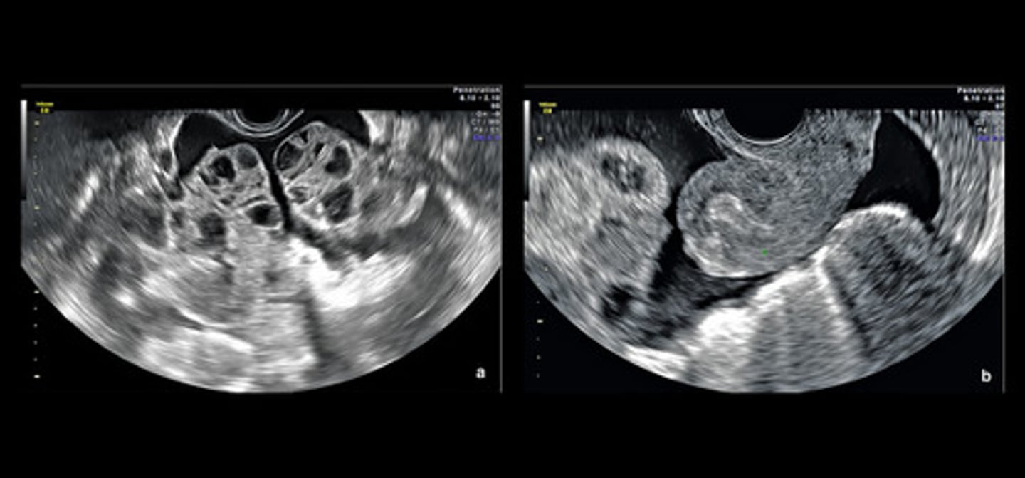 <p>ascites; pleural effusions</p>