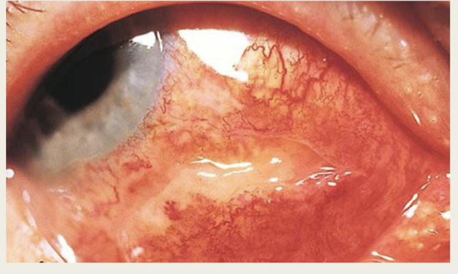 <p>rolled conjunctival tissue</p><p>conj chemosis</p><p>conj hemorrhage</p>
