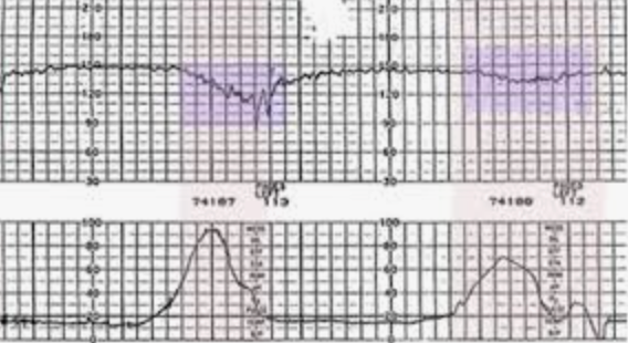 <p>Late decels are due to </p>