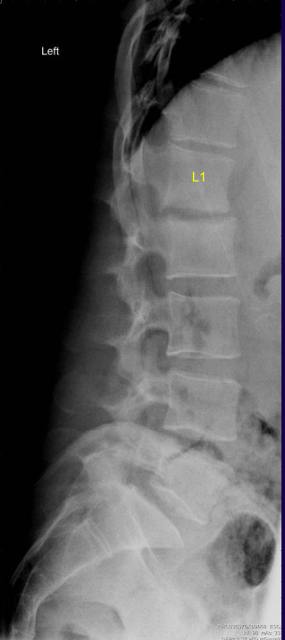 <p>What findings and condition are present in this image?</p><p>30 yo IV drug user w intense back pain</p>