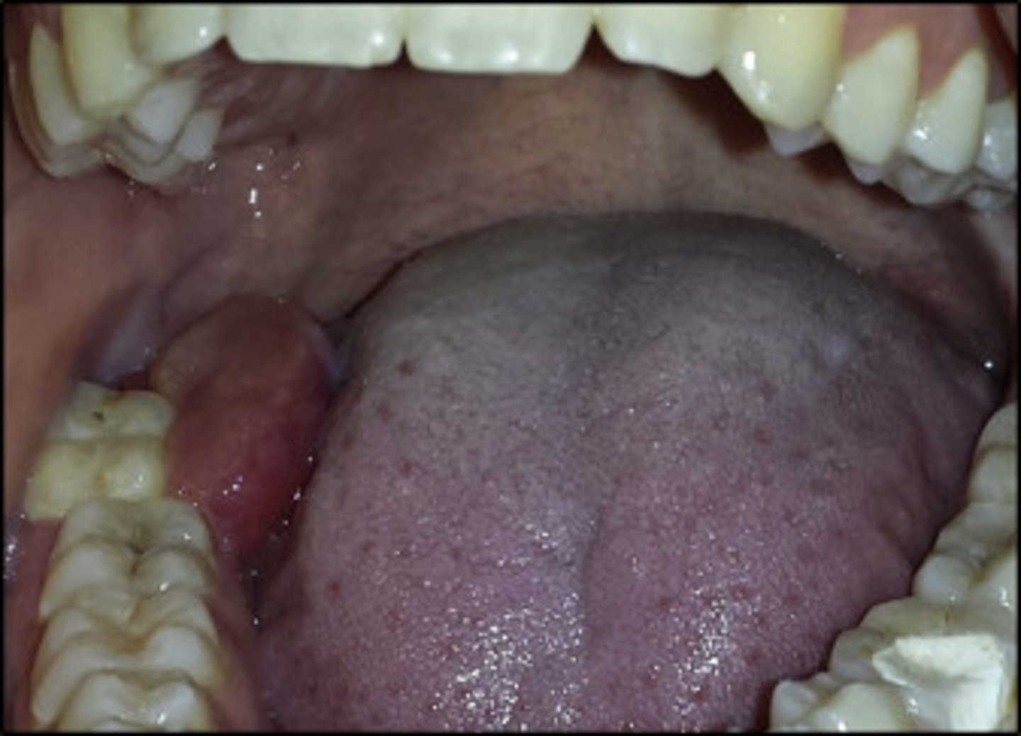 <p>•Rare myofibroblastic neoplasm</p><p>•Most common in mandible, but peripheral lesions often develop</p>