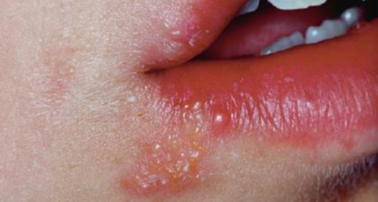 <p>herpes labialis</p>
