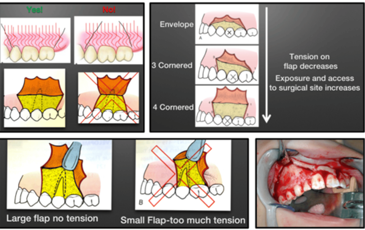 <p>Tension of a surgical flap _____ as exposure and access to surgical site ______</p><p>-KNOW</p>