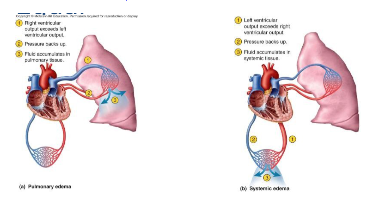 -fluid accumulation in either circuit due to insufficiency of ventricular pumping
-Common causes: myocardial infarction (MI), chronic hypertension, valvular defects, and congenital birth defects in cardiac anatomy
