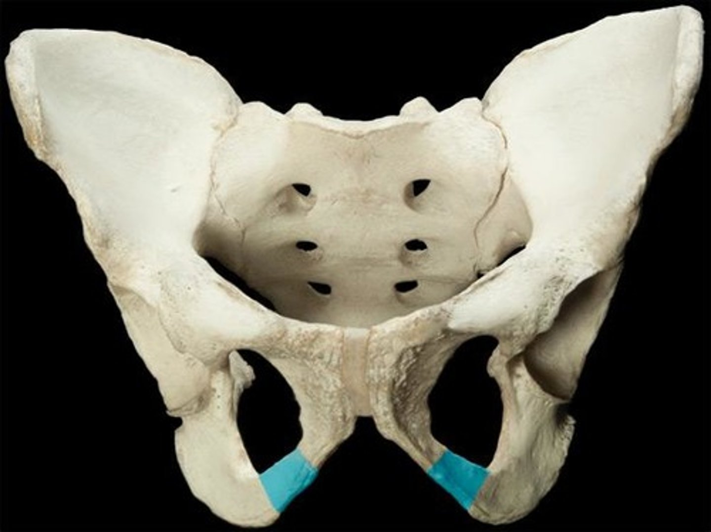 <p>inferior process; unites with inferior pubic ramus inferior to obturator foramen</p>