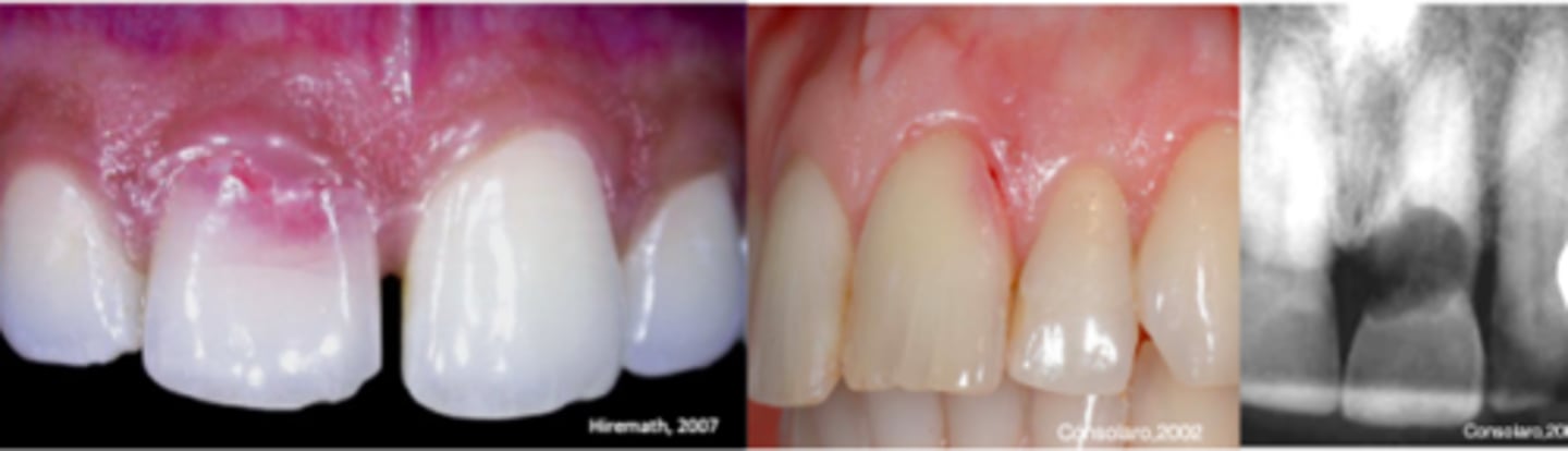 <p>Resorption (external cervical/invasive cervical resorption)</p>