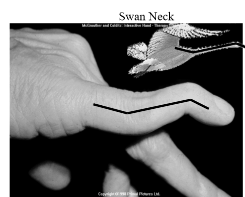 <p>b. swan neck deformity (caused by hyperextension of the PIP joint and flexion of the DIP joint)</p>