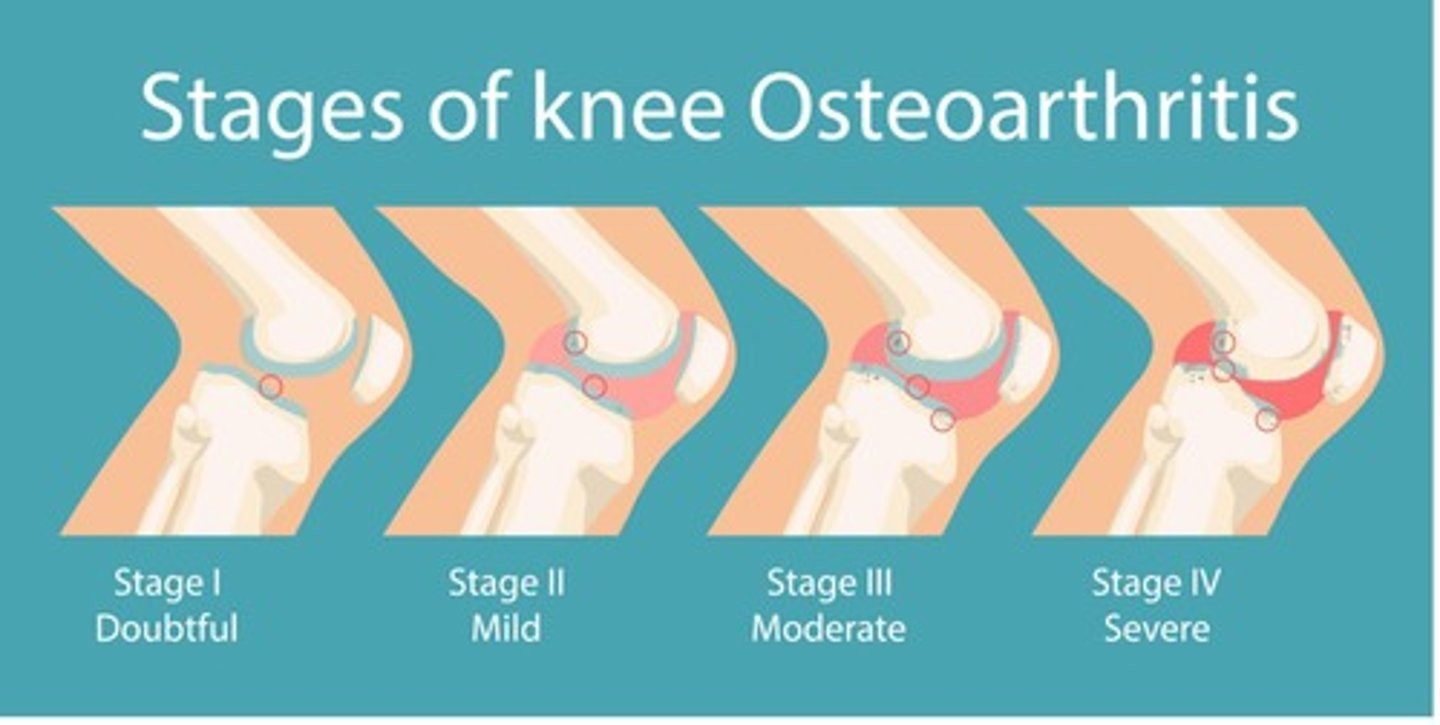 <p>If progression is severe, bone on bone, it develops spurs first and then all cartilage is gone. Surgery is then the only option</p>