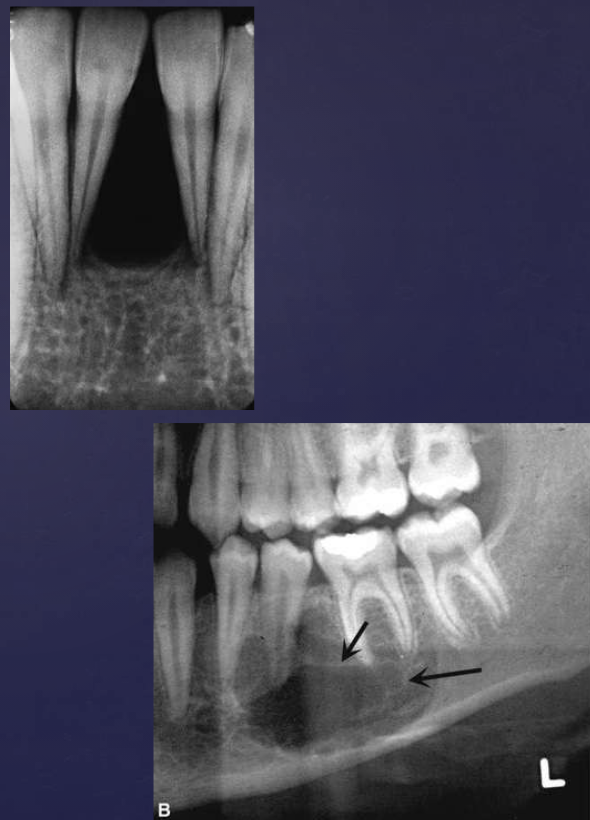 <ol><li><p>well defined periphery, not corticated generally</p></li><li><p>radiolucent: small lesions</p></li><li><p>internally: subtle granular calcifications, thin wispy septae</p></li><li><p>if adjacent to teeth: absence of lamina dura  </p></li></ol><p></p>
