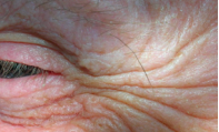 <p>EXPECTED AGE-RELATED CHANGES</p><p>Are fine lines that form on the outer corners of your eyes</p><p></p>