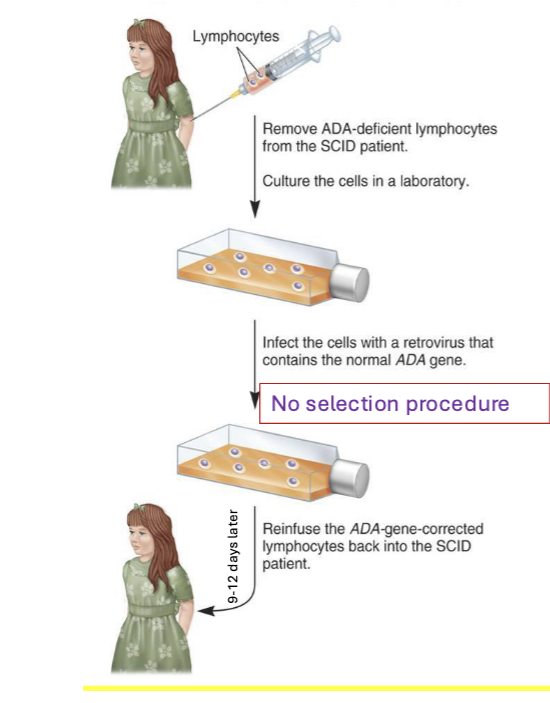 <ul><li><p>2 girls (4 and 9) with ADA-SCID = <strong>first gene therapy recipients</strong></p></li><li><p>ADA gene delivered into patient lymphocytes using <strong>retroviral vectors; ex vivo therapy</strong></p></li><li><p>patients continued to receive ADA protein replacement therapy</p></li><li><p>immune systems restored</p></li><li><p>process</p><ul><li><p>remove ADA-deficient lymphocytes from SCID patient → culture the cells in a lab</p></li><li><p>infect the cells with a retrovirus that contains the normal ADA gene</p></li><li><p><strong>no selection procedure</strong></p></li><li><p>reinfuse the ADA-gene-corrected lymphocytes back into the SCID patient</p></li></ul></li><li><p><strong>both girls had the transgene years after treatment and exhibited robust immune systems</strong></p></li></ul><p></p>
