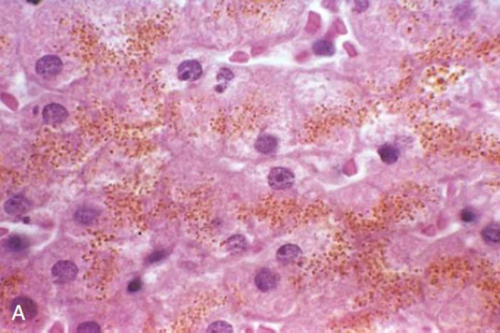 <p>In Perls’ Prussian Blue Test, ferritin reacts with _____ in the stain to form <strong>insoluble Prussian blue dye in situ</strong></p>