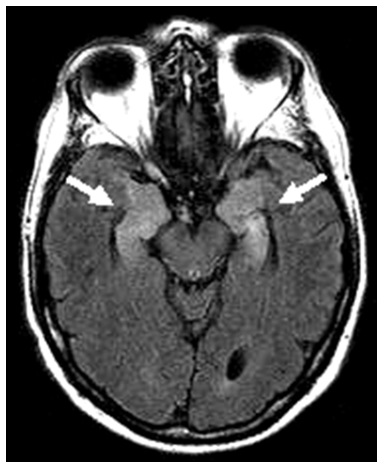 <p>limbic encephalitis </p>