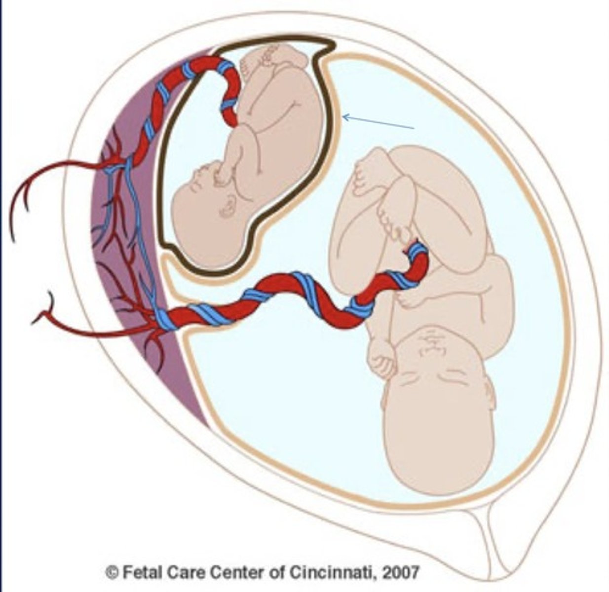 <p>Seen in monochorionic diamniotic twins with TTTS</p><p>Severe polyhydramnios of 1 twin, and oligohydranmios of the other</p><p>Little/no movement of babies</p>