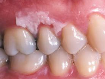 <p>necrotic pseudomembrane that can be scraped off, due to chemical sensitivity</p>