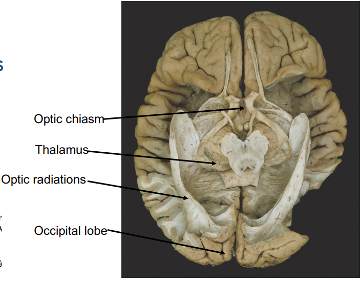 <p>White matter tract that goes from the thalamus to the occipital lobe</p><p></p>