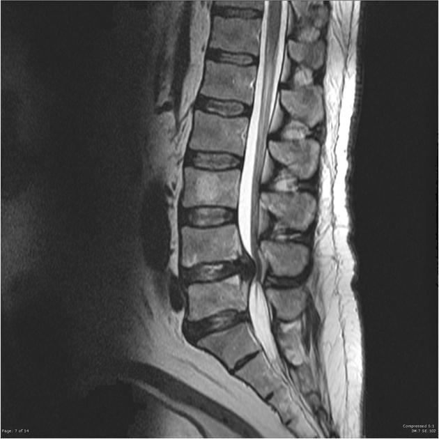 <p>Name this pathology. What structure is it impinging on?</p>