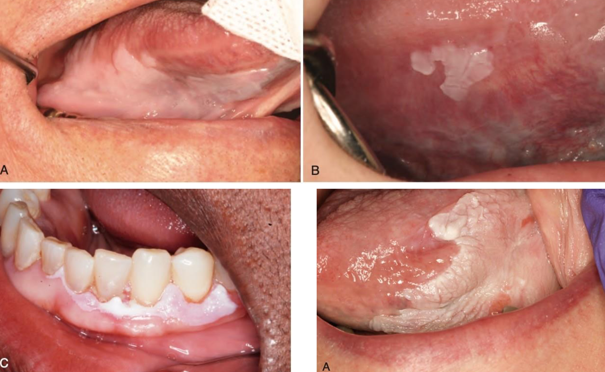 <p>which neoplastic white lesion:</p>
