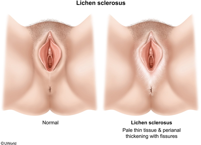 <p>young (prepubertal) and old (postmenopausal) vulva-havers, as they are <strong>low estrogen</strong></p>