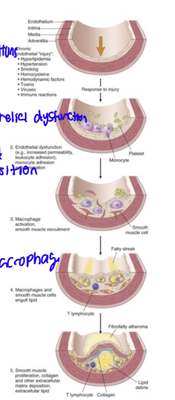 <p>chronic condition (endothelial injury) → endothelial dysfunction→macrophage activation→SMC/ Macrophage engulf lipid→deposition →plaque thickens </p>