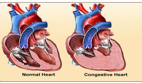 <p>These can happen when there's a problem with the heart's structure or how it works, making it hard for the lower chambers (ventricles) to either fill up with blood or pump it out properly.</p><p>This heart failure or Congestive heart failure (CHF) can result in:</p><ul><li><p>Too much fluid can build up in the lungs, causing swelling (edema).</p></li><li><p>Less blood gets pumped out to the rest of the body.</p></li><li><p>The kidneys hold onto more fluid.</p></li></ul><p></p>