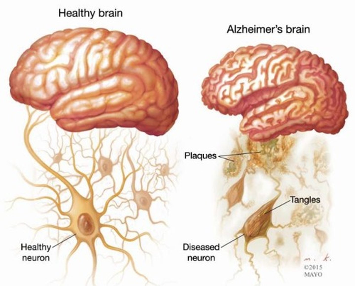 <p>Progressively degenerative brain disease; mostly seen in elderly; structural changes in the brain occur; protein deposits result in death of neurons; victims experience memory loss, mood changes and ultimately death</p>