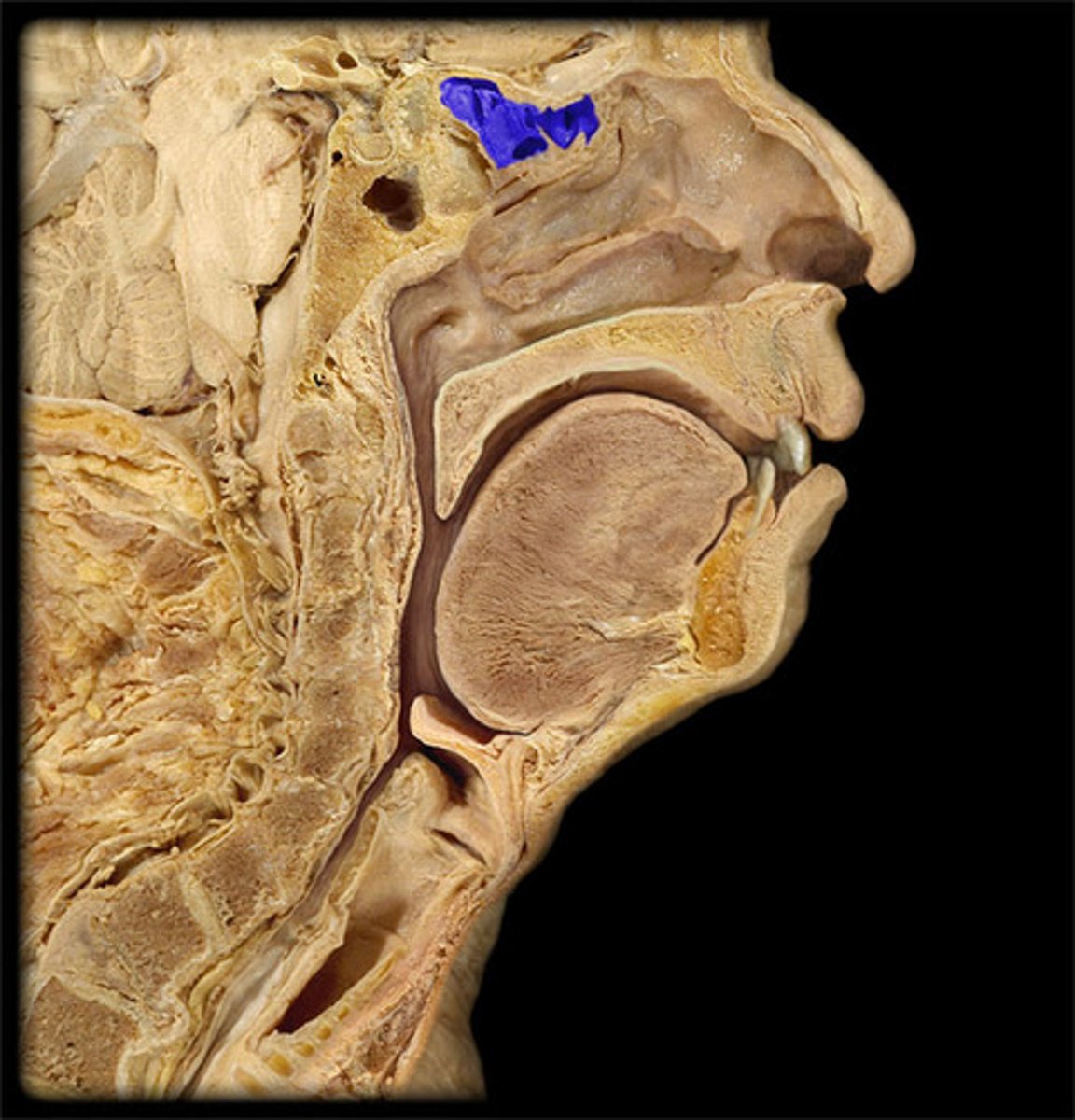 <p> TA will pinch between nose</p><ul><li><p>space</p></li></ul><p></p>