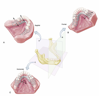 <ul><li><p>occurs on midline, lingual to anterior teeth</p></li><li><p>Rotational movement in horizontal plane</p></li><li><p>Stabilising components are reciprocal arm and minor connectors</p></li><li><p>Rigid primary connector</p></li><li><p>closely adapted denture base</p></li></ul><p></p>