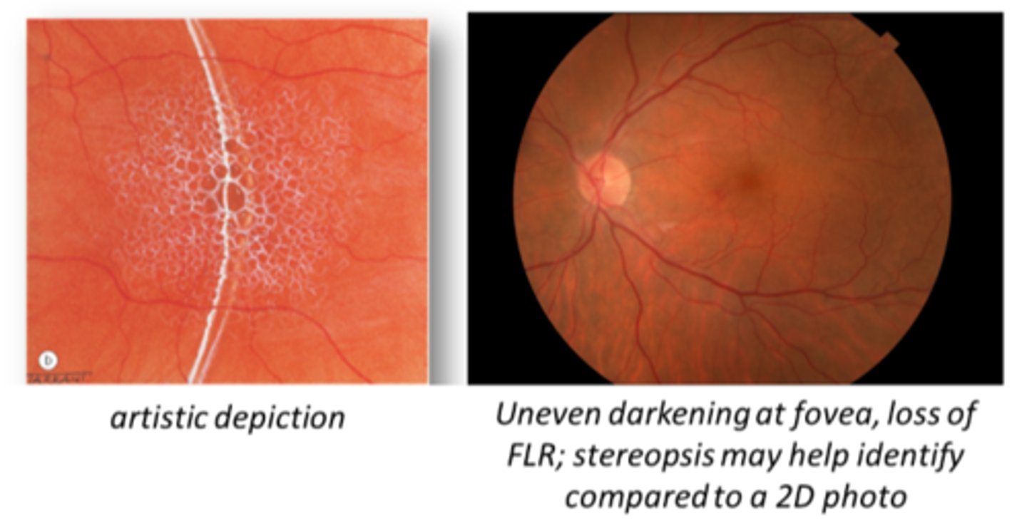 <p>loss of FLR</p><p>loss of foveal depression = may see elevation, shading, shadowing, lighter areas</p>