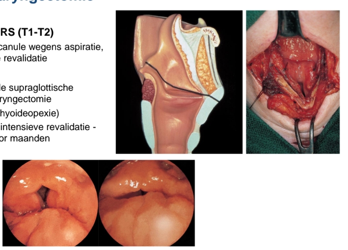 <p>Laser of TORS (T1-T2)<br>Tijdelijke canule wegens aspiratie, intensieve revalidatie<br></p><p>Extern<br>Horizontale supraglottische<br>partiële laryngectomie<br>Met (cricohyoideopexie)<br>Aspiratie: intensieve revalidatie -<br>canule voor maanden</p><p>(oefenen om slik functie terug te krijgen)</p>