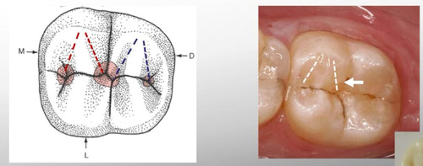 <p>On occlusal surface of posterior teeth, the ridge from any cusp tip to the center of the occlusal surface.</p>
